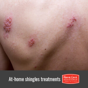 5 Ways to Treat Your Senior Loved One’s Shingles